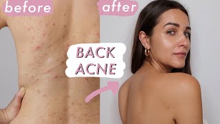 HOW TO GET RID OF BACK ACNE (bacne)