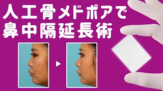 【術式の進化！人工骨メドポアを使った鼻中隔延長術】（手術シーン無し）