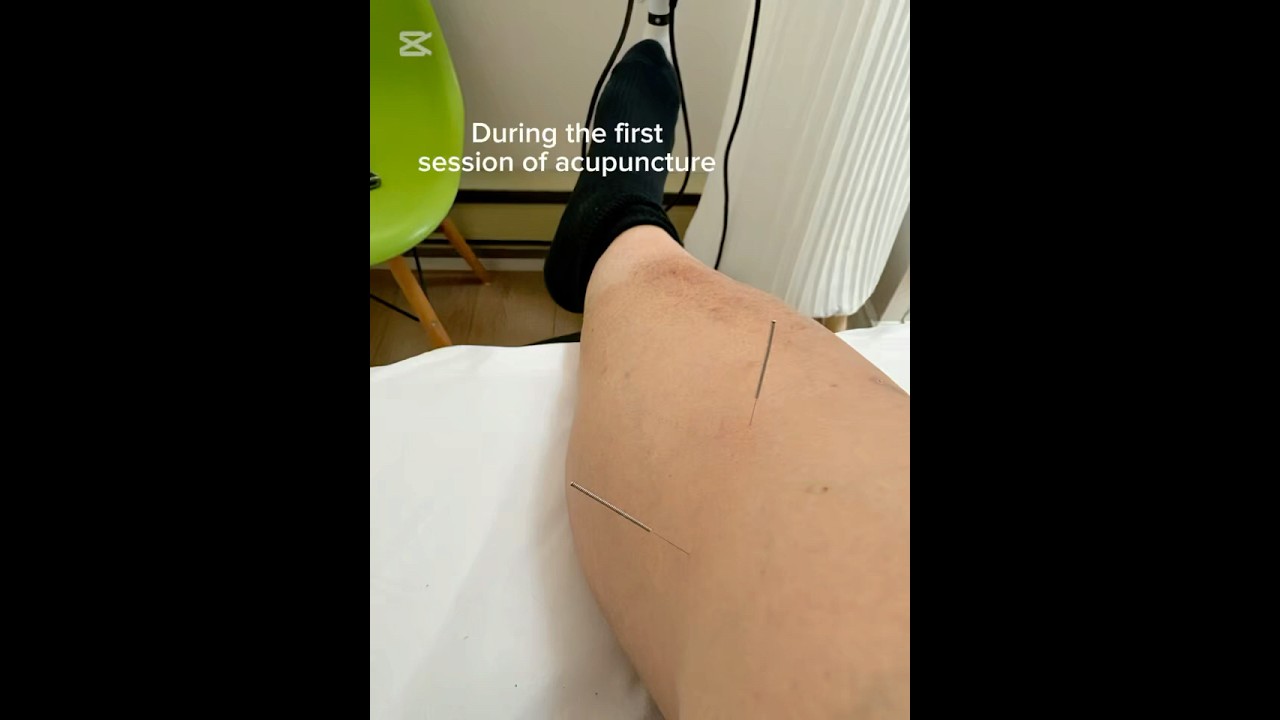 Gout Treatment Near Me with Acupuncture