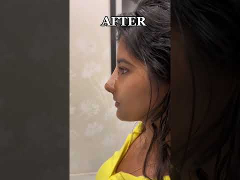 Revision Rhinoplasty for my beautiful patient from India 🇮🇳🤍 #rhinoplasty #nosejob #india