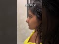 Revision Rhinoplasty For My Beautiful Patient From India Rhinoplasty Nosejob India
