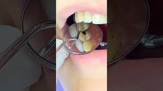 Tooth Decay Removal #toothdecay #toothache #dentalclinic #klinikedentaretirane