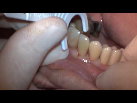 Prosthodontics Video: Implant retained bridge