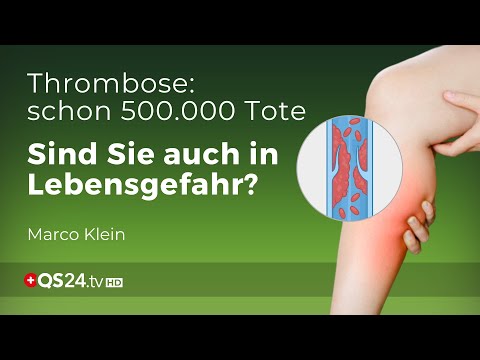 Thrombose – Prophylaxe und Behandlung | Kleinsche Felder | Marco Klein | QS24 Gesundheitsfernsehen