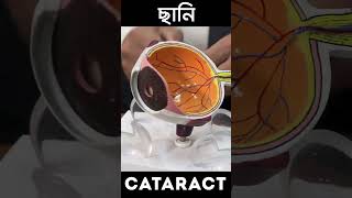 Don't Let Cataracts Cloud Your Vision! | চোখের ছানি | CATARACT | Dr. Siddiqur Rahaman