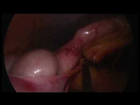 Chirurgia przez naturalne otwory ciała - przezpochwowe usunięcie wyrostka robaczkowego