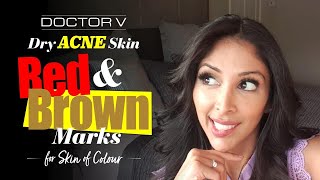 Doctor V - Dry Acne Skin Red And Brown Marks For Skin Of Colour | Brown or Black Skin