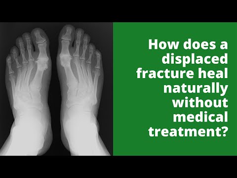 How does a displaced fracture heal naturally without medical treatment?