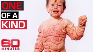 Download lagu Medical mystery: Boy living with rare excess skin condition | 60 Minutes Australia mp3
