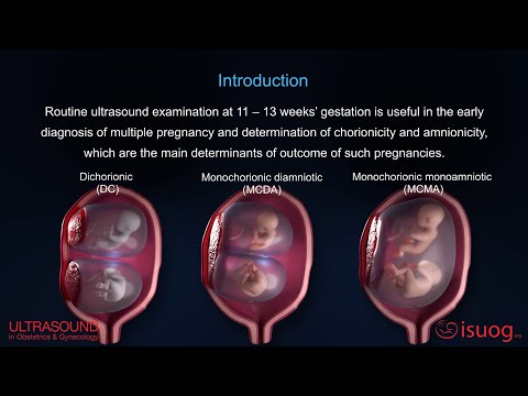 UOG video abstract: Outcome of twin pregnancy with two live fetuses at 11–13 weeks’ gestation