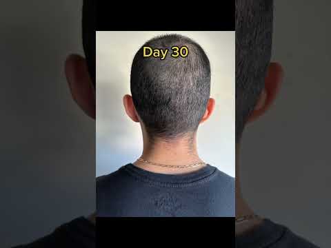 Donor area  after a #fuehairtransplant #hairtransplantcolombia #hairtransplant #bogotahairlines