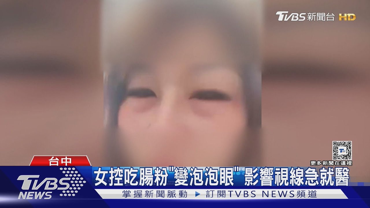 女控吃腸粉「變泡泡眼」！影響視線急就醫