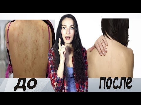 На коже пигментные пятна чешутся Отбеливающий крем для анального
