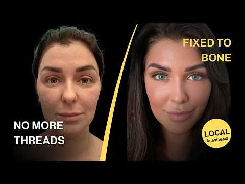 Permanent Brow Lift & Cat Eyes – Bone-Lock System