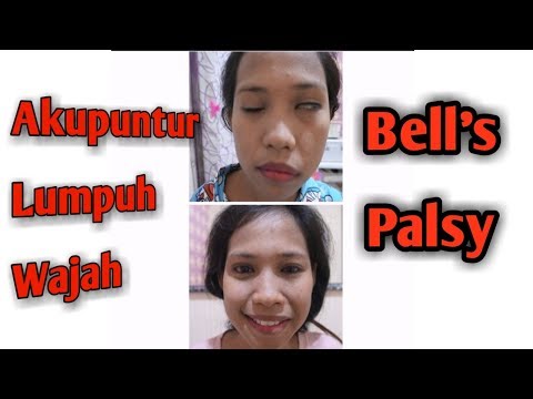 Shunting dan potensi Meningkatkan pembukaan penis