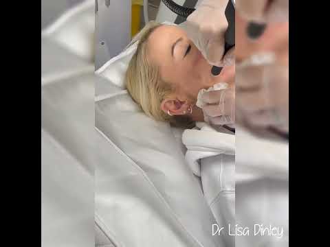 The Zaffiro Neauvia Hydro-Exfoliation Treatment