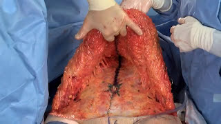 True Form Tummy Tuck® in Surgery