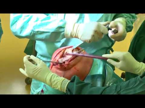 ÑƒÐ½Ñ Ñ, Noe Ð ± оР»Ð½Ð ° Ñ NOE пинÐμ Arthrose der Hand und Fußgelenke herunterladen