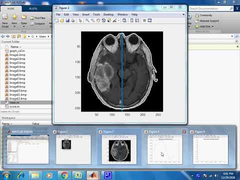 Brain tumor detection in matlab