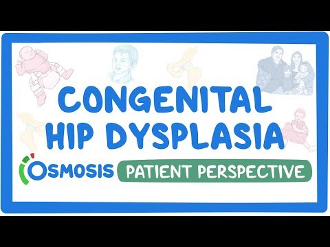 Patient Perspective: Congenital hip dysplasia