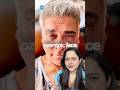 What Is Ozempic Face Which Celebrities Are Taking Hauterrfly Ozempic
