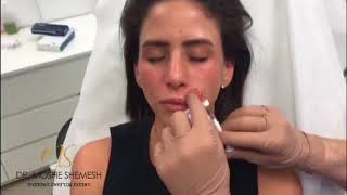 העלמת הקמטים בצידי הפה (קמטים נזו-לביאליים) בהזרקת החומצה היאלורונית (רסטילן) - דר' משה שמש