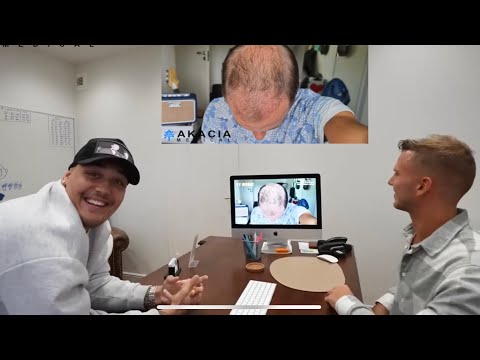 Rasmus (23) – hårtransplantation med 2200 hårsäckar