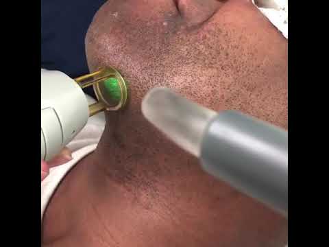 Laser Hair Removal for treatment of Pseudofilliculitis...