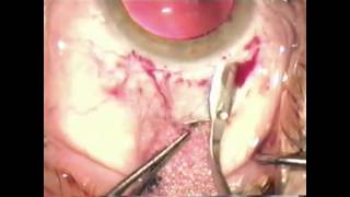 Peritomy and groove technique