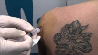 INFILTRACIÓN DE HOMBRO - Tendinitis manguito rotador