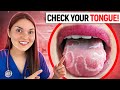 What your TONGUE says about your HEALTH: Doctor Explains
