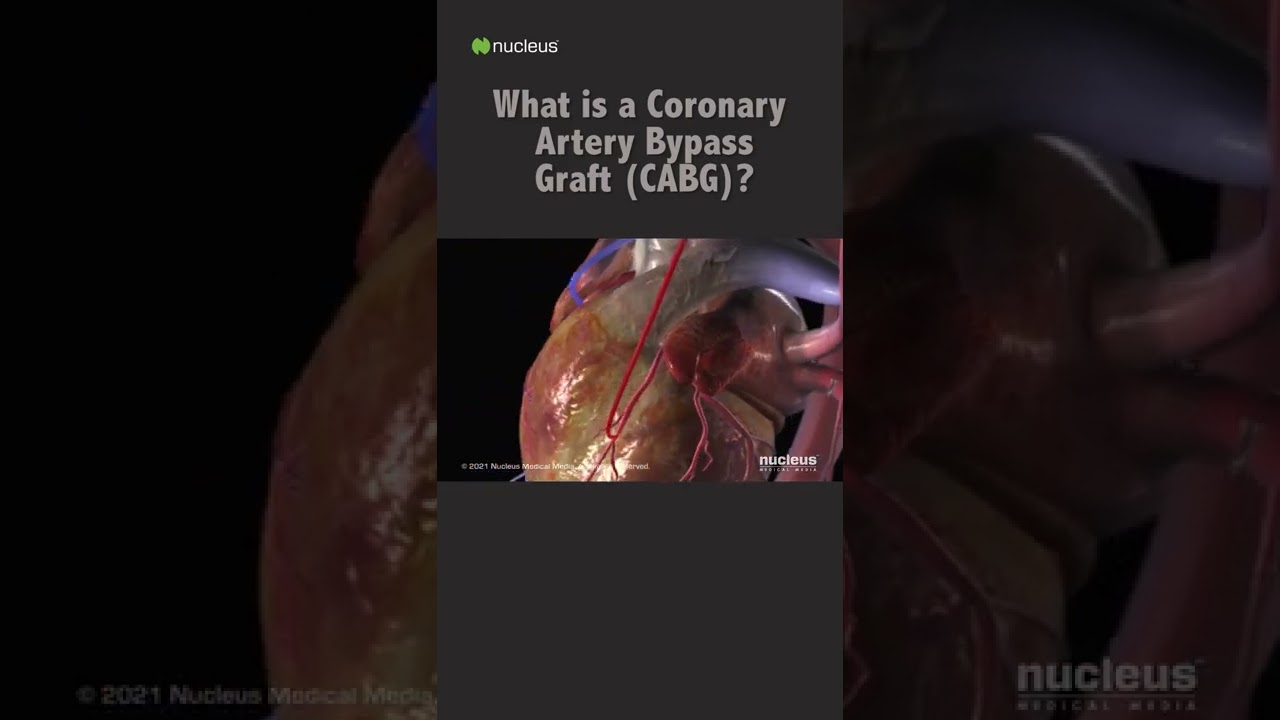 What is a Coronary Artery Bypass Graft (CABG) #shorts