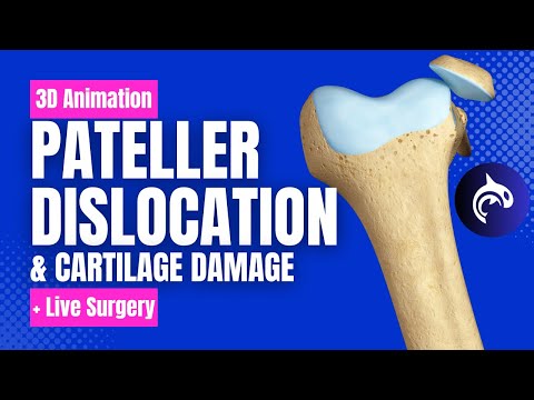 ACL Anterior Cruciate Ligament MCL Medial Collateral Ligament Tear and Repair No Narration