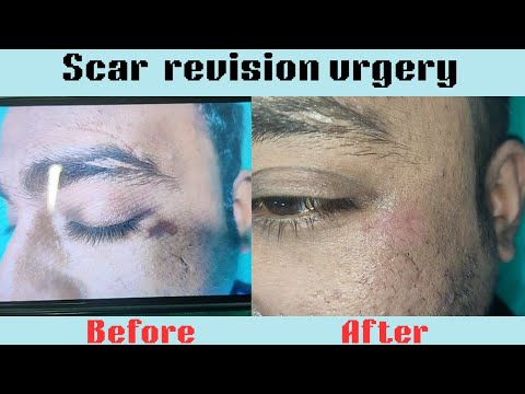 💯% Result in scar revision surgery| scar revision surgery in Ranchi | Best treatment of scar