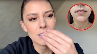 BOTOX LIP FLIP RESULTS AND REVIEW!