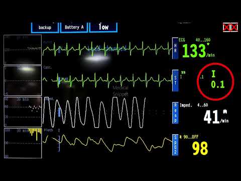 ECG in Pulmonary embolism