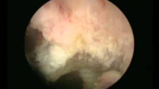 Διουρηθρική προστατεκτομή