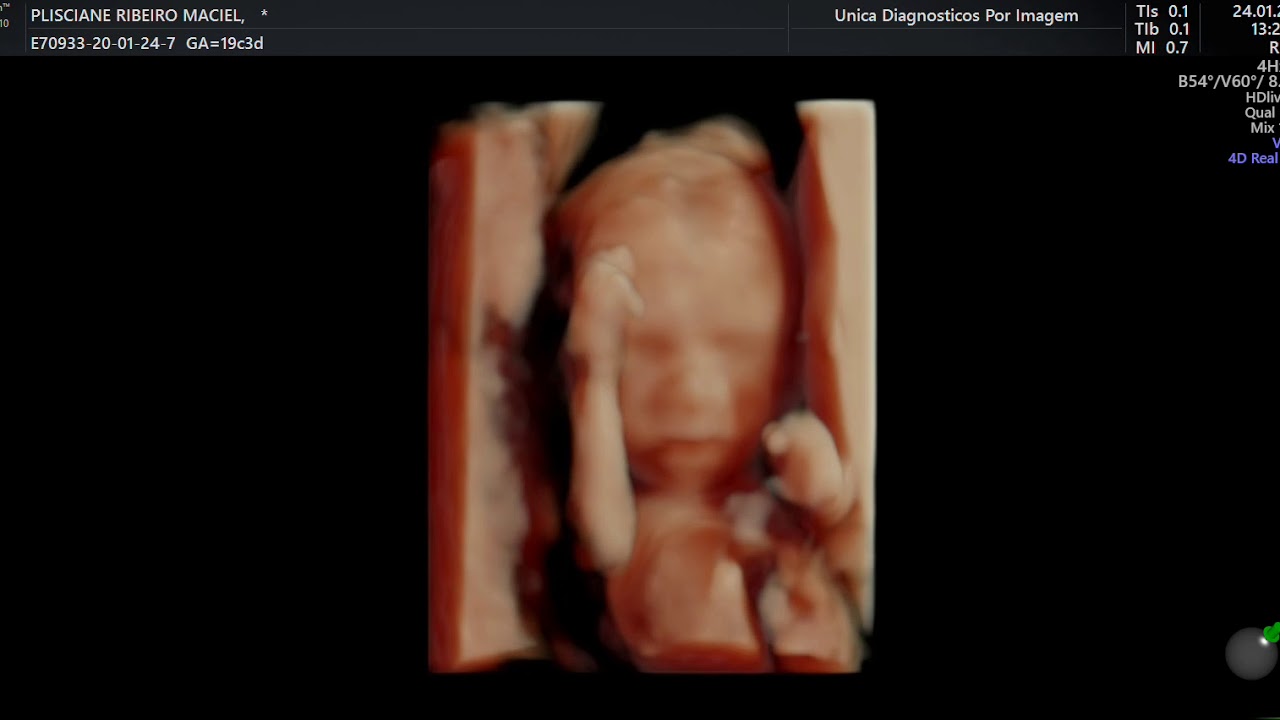 VÍDEOS DE ULTRASSONOGRAFIA EM 3D 4D DE UM BEBE DE 19 SEMANAS DENTRO DO ÚTERO DA SUA MAMÃE