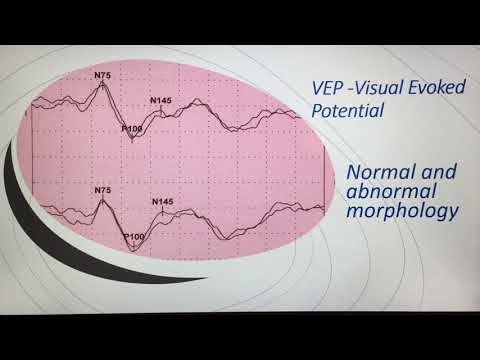 Visual Evoked Potential (VEP)