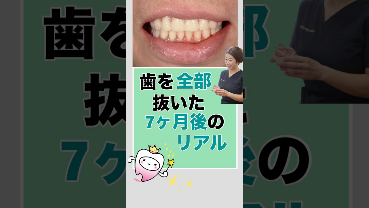 歯を全部抜いた7ヶ月後のリアル #仮歯 #入れ歯 #抜歯後即時義歯#総入れ歯