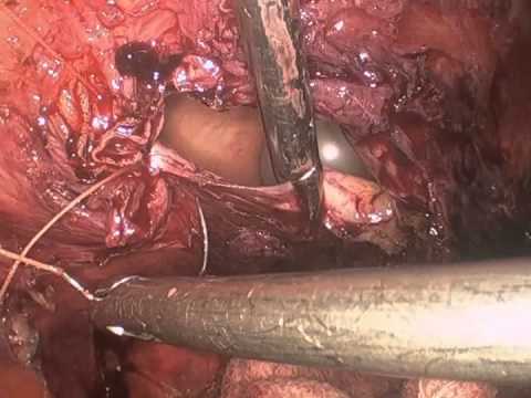 Laparoskopowa naprawa uszkodzenia pęcherza moczowego rozpoznanego podczas histerektomii