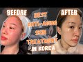 Trying Korean Anti-Aging Treatment in Korea | Renovo Skin Clinic
