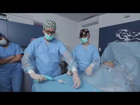 VenaBlock GSV Treatment