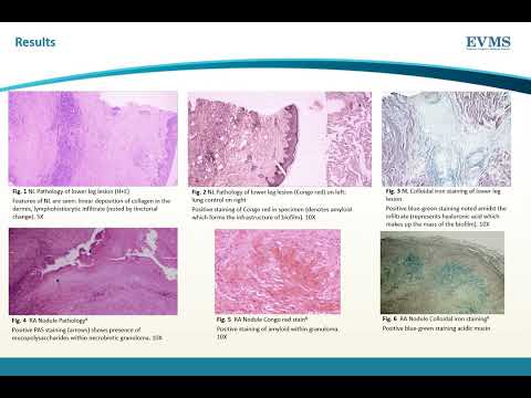 Thumbnail image of video presentation for Biofilms in Necrobiotic Granulomas