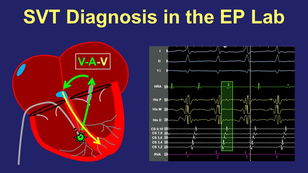 Diagnosis of SVT in the EP lab