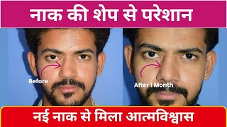 नाक की सर्जरी का ऐसा रिज़ल्ट पहले कभी नहीं देखा होगा | सुनिए मरीज की खुशी | Rhinoplasty by Dr Sunil