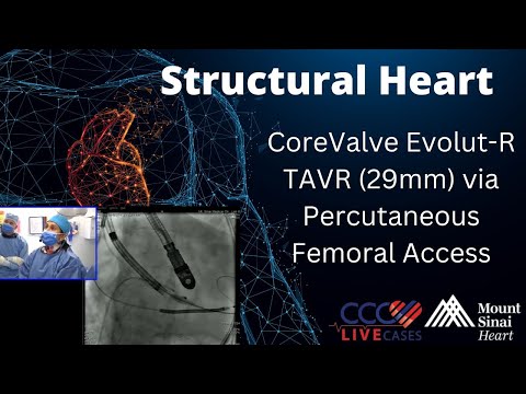 CoreValve Evolut-R TAVR (29mm) via Percutaneous Femoral Access - Structural Heart Case - June 2016