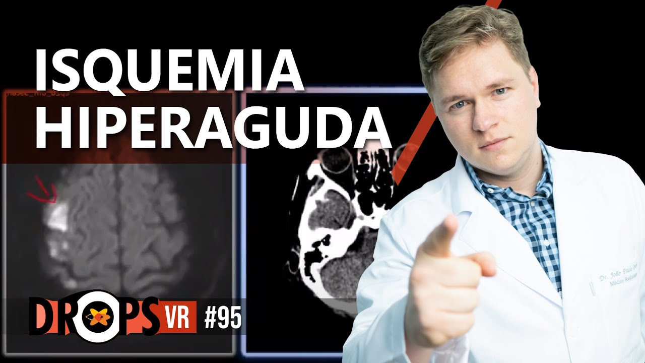 SINAIS RADIOLÓGICOS DE ISQUEMIA HIPERAGUDA | TC E RM DE CRÂNIO