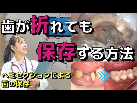 生命歯学科 歯が折れてしまっていても、歯根に穴が空いてしまっていても残せる可能性がある？！虫歯や歯周病で残せないと言われた歯を残す！歯根の片足を残すヘミセクション治療とは？