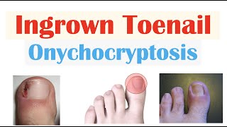 Ingrown Toenail (Onychocryptosis) | Causes, Risk Factors, Signs & Symptoms, Diagnosis, Treatment